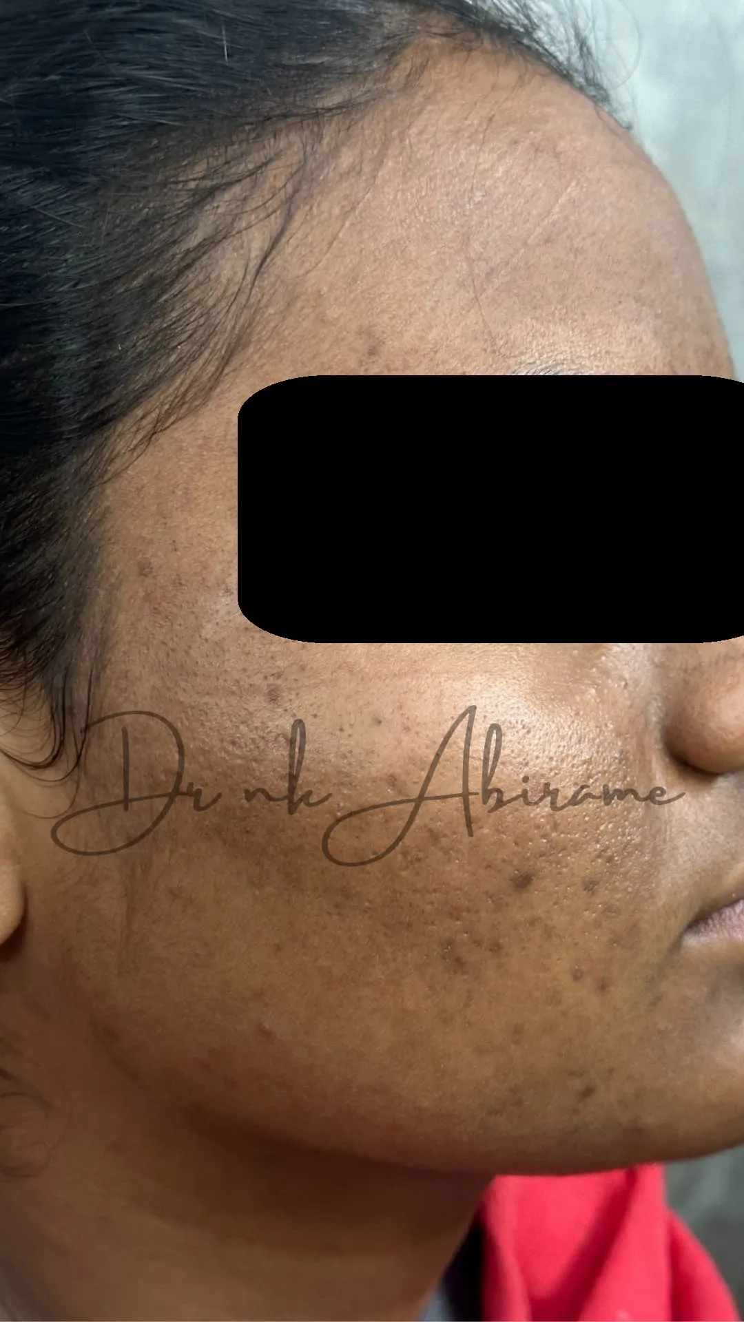 After treatment